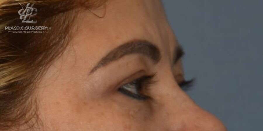 Blepharoplasty (Eyelid Surgery), patient 1, after, view 3