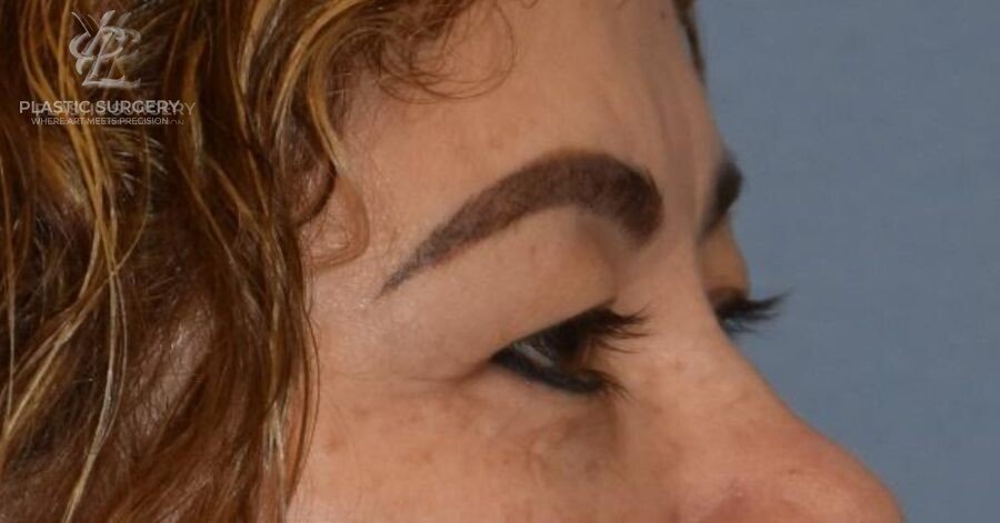 Blepharoplasty (Eyelid Surgery), patient 1, before, view 3