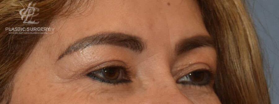 Blepharoplasty (Eyelid Surgery), patient 1, after, view 2