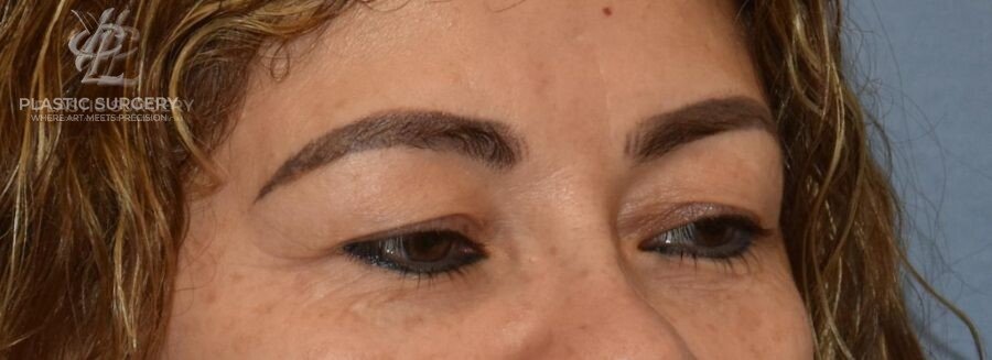 Blepharoplasty (Eyelid Surgery), patient 1, before, view 2