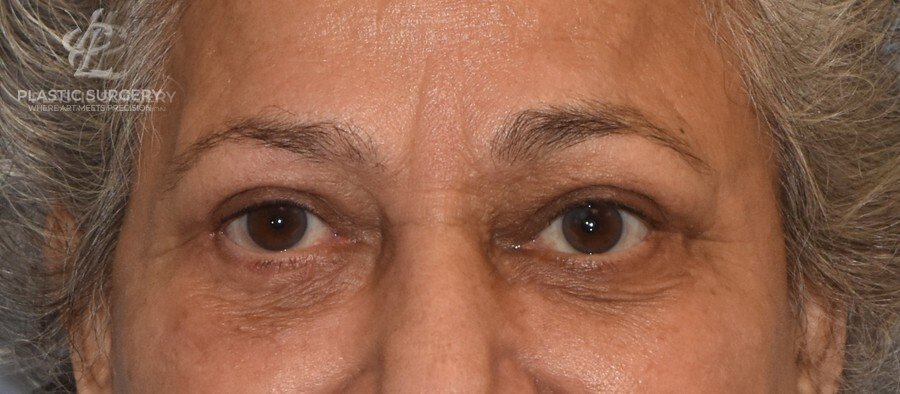 Blepharoplasty (Eyelid Surgery), patient 2, after, view 1