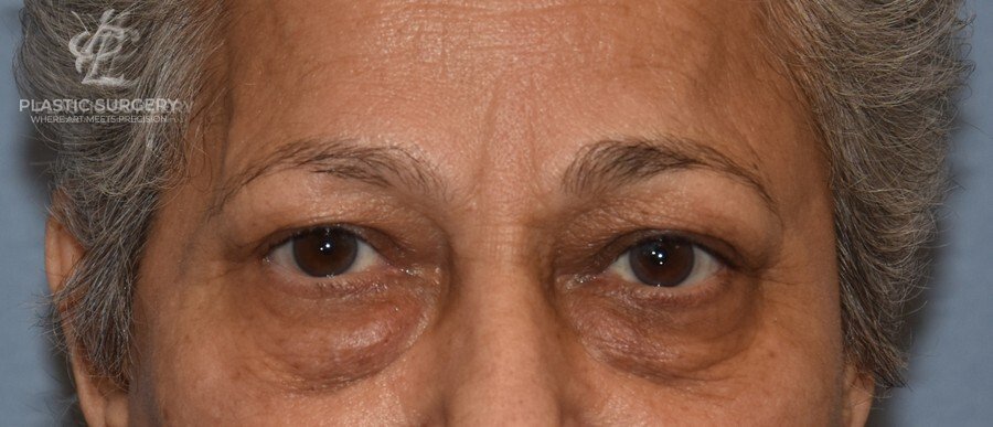 Blepharoplasty (Eyelid Surgery), patient 2, before, view 1