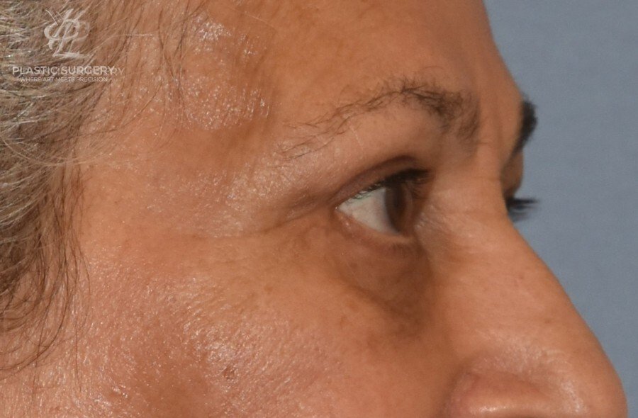 Blepharoplasty (Eyelid Surgery), patient 2, after, view 3
