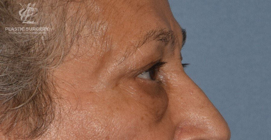 Blepharoplasty (Eyelid Surgery), patient 2, before, view 3