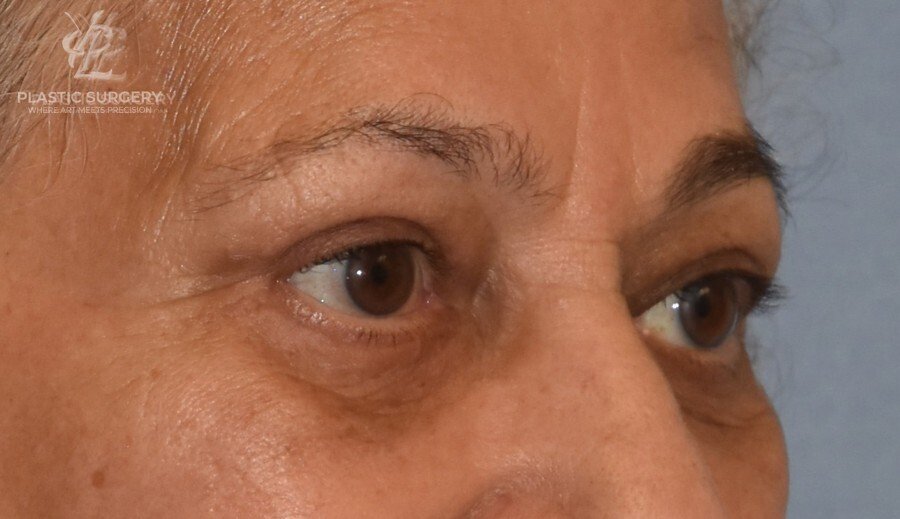 Blepharoplasty (Eyelid Surgery), patient 2, after, view 2