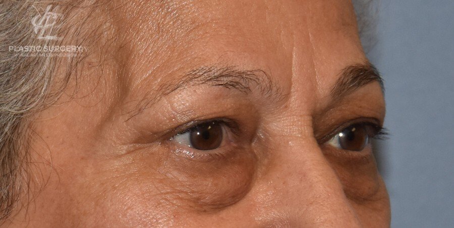 Blepharoplasty (Eyelid Surgery), patient 2, before, view 2
