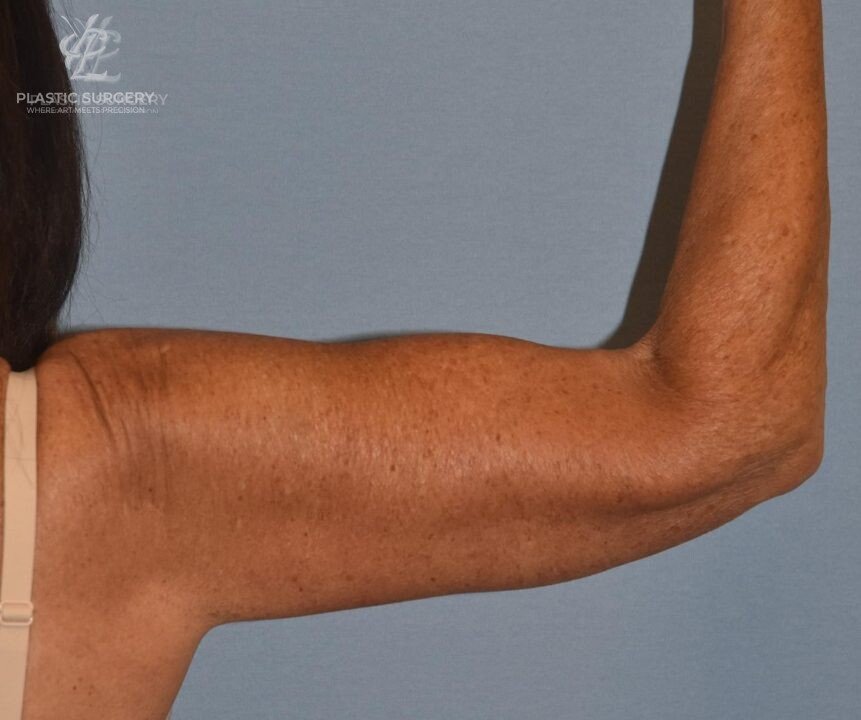 Brachioplasty (Arm Lift), patient 1, after, view 1