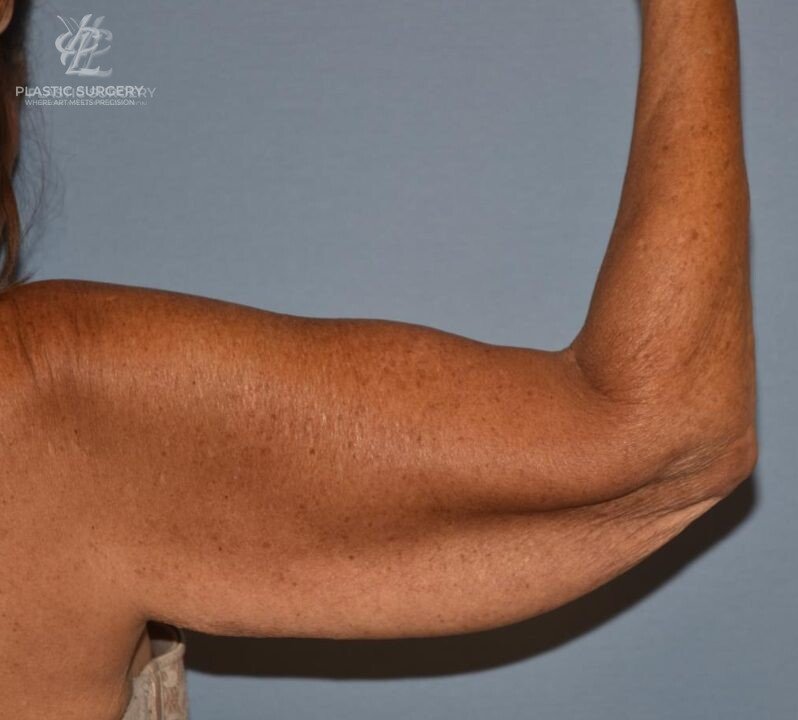 Brachioplasty (Arm Lift), patient 1, before, view 1