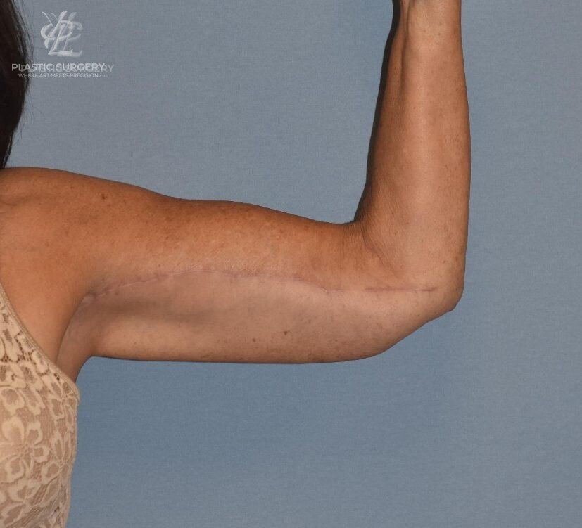 Brachioplasty (Arm Lift), patient 1, after, view 2