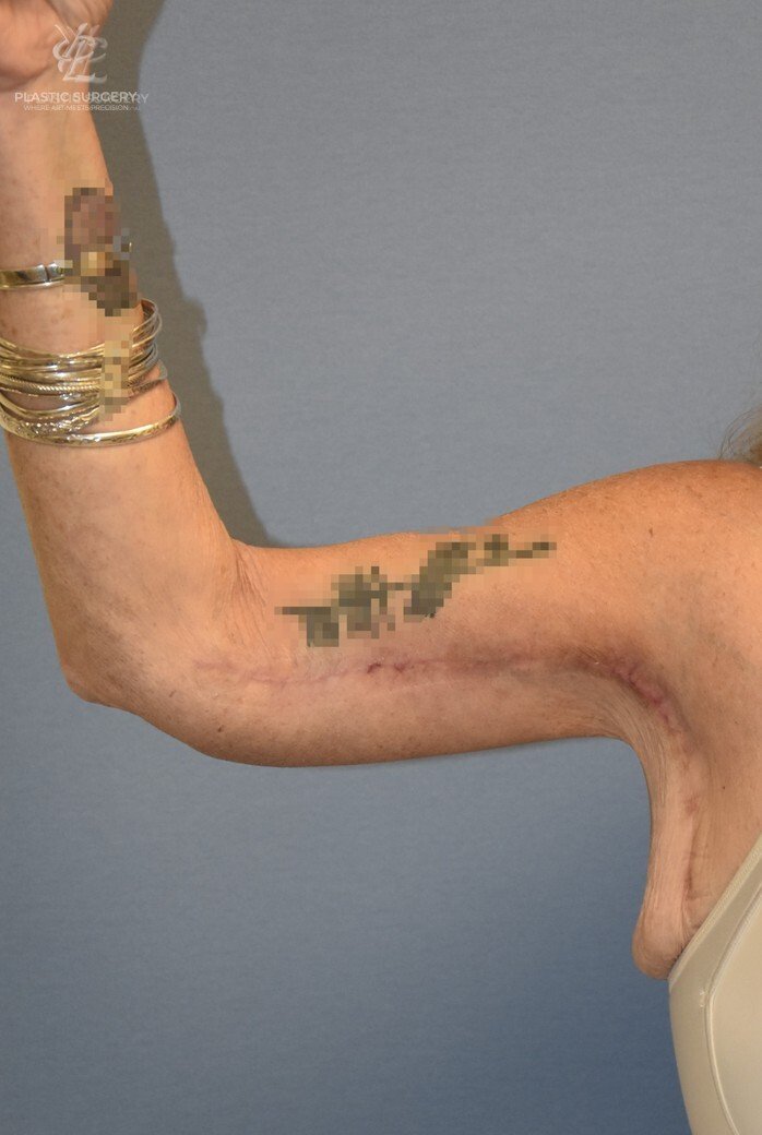 Brachioplasty (Arm Lift), patient 2, after, view 1