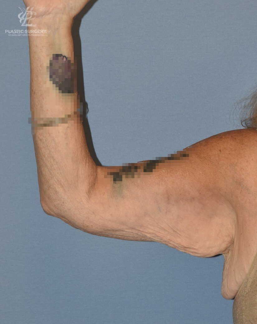 Brachioplasty (Arm Lift), patient 2, before, view 1
