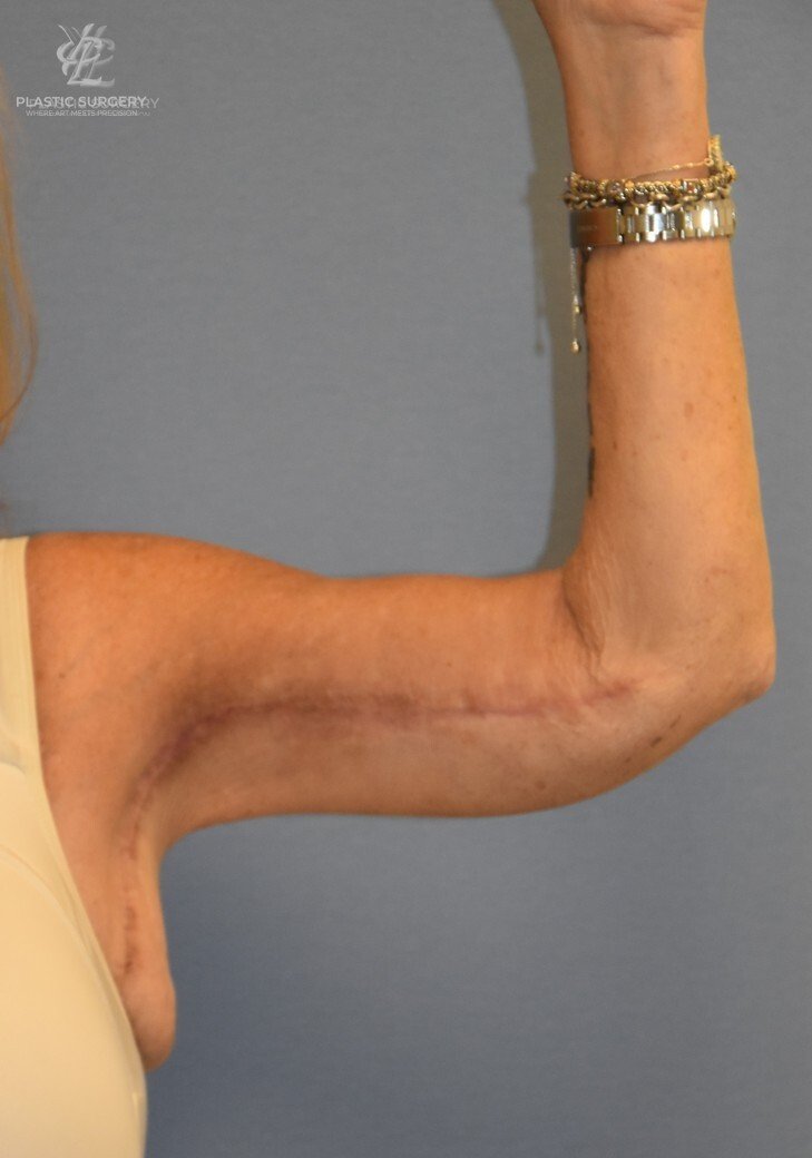 Brachioplasty (Arm Lift), patient 2, after, view 2