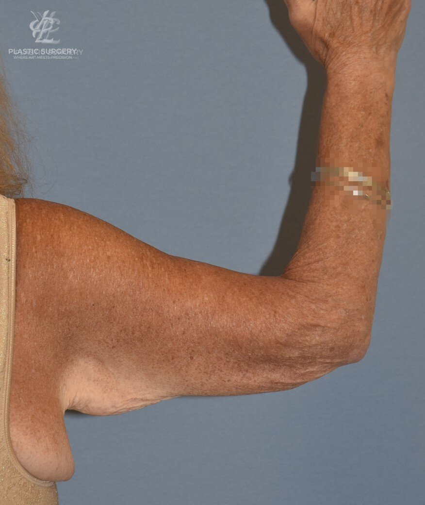 Brachioplasty (Arm Lift), patient 2, before, view 2