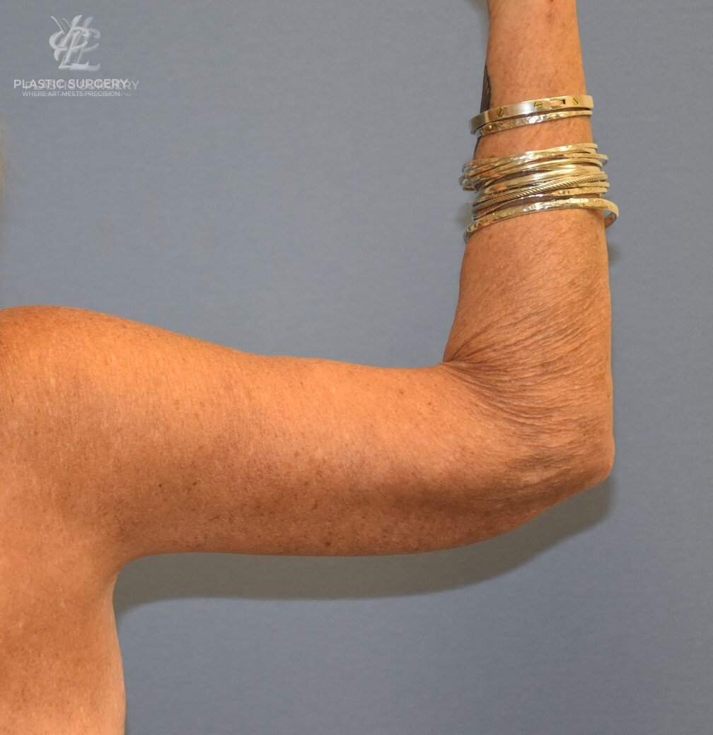 Brachioplasty (Arm Lift), patient 2, after, view 3