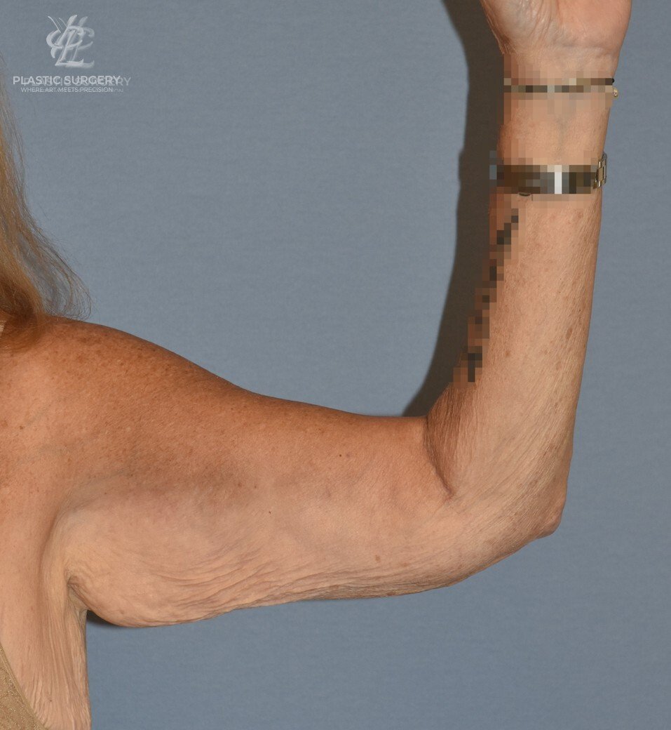 Brachioplasty (Arm Lift), patient 2, before, view 3
