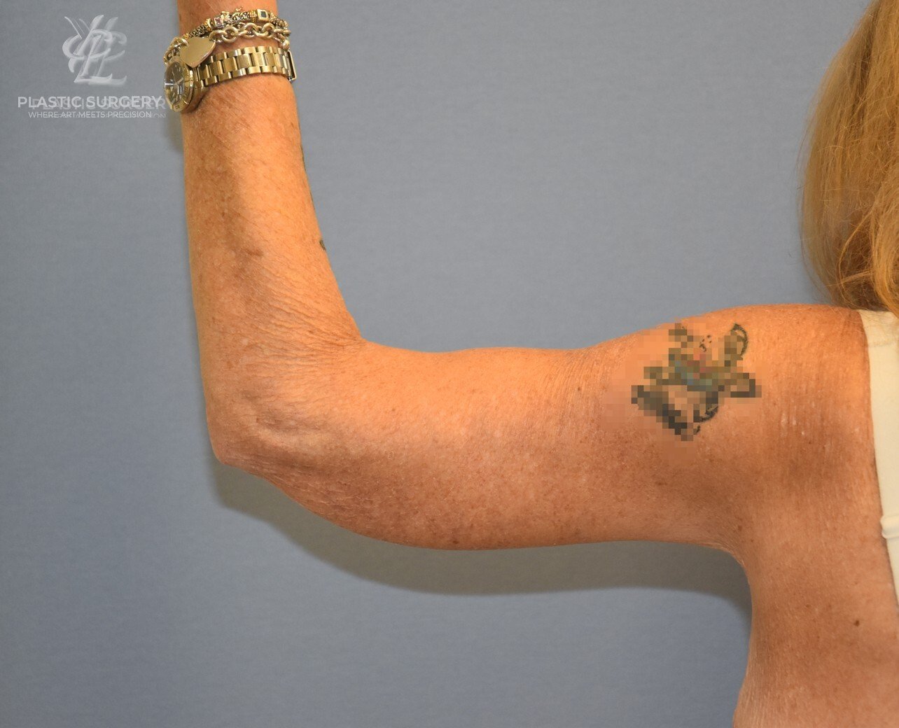 Brachioplasty (Arm Lift), patient 2, after, view 4