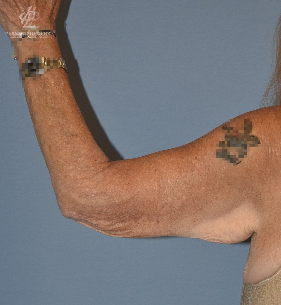 Brachioplasty (Arm Lift), patient 2, before, view 4