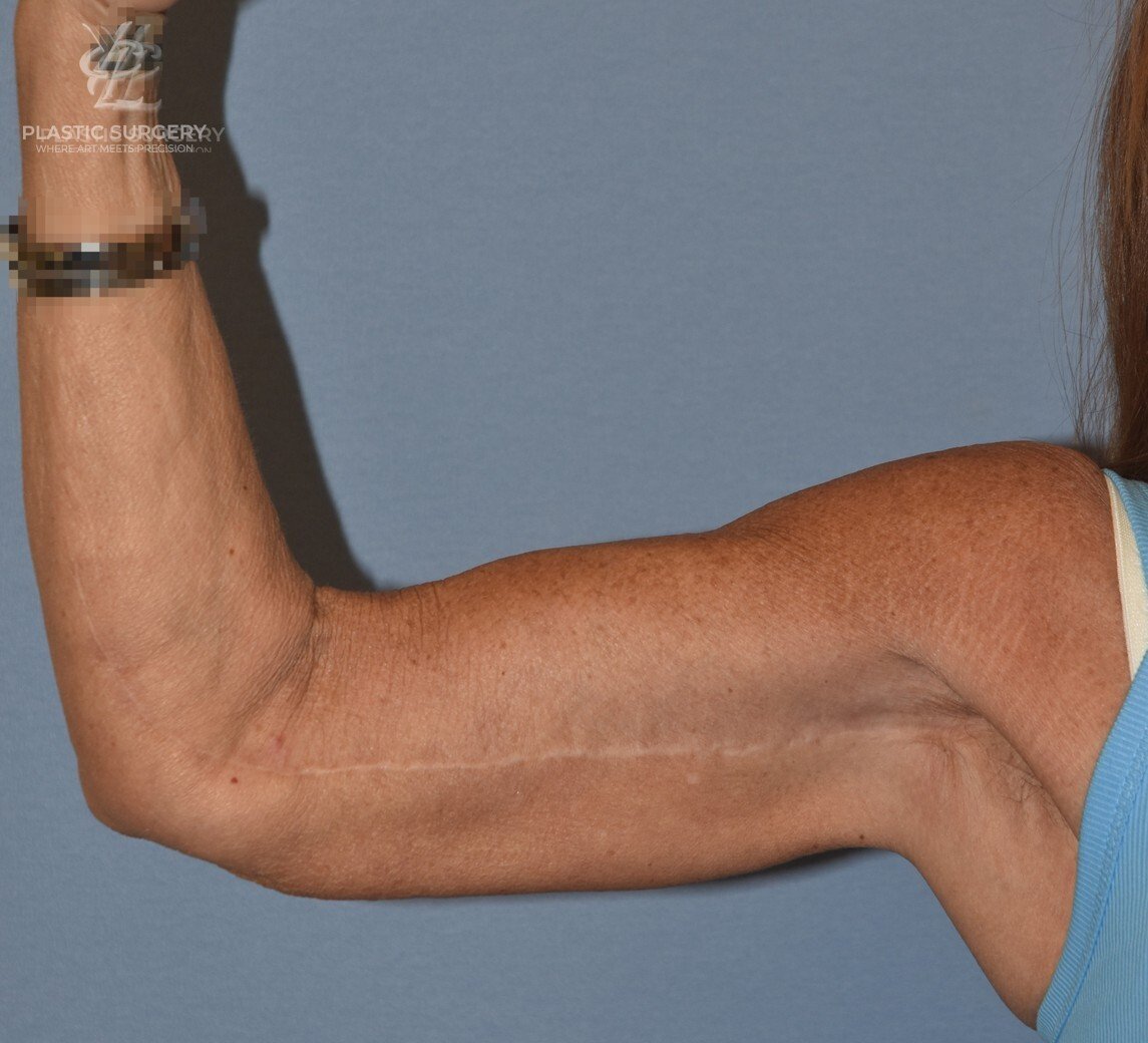Brachioplasty (Arm Lift), patient 3, after, view 1