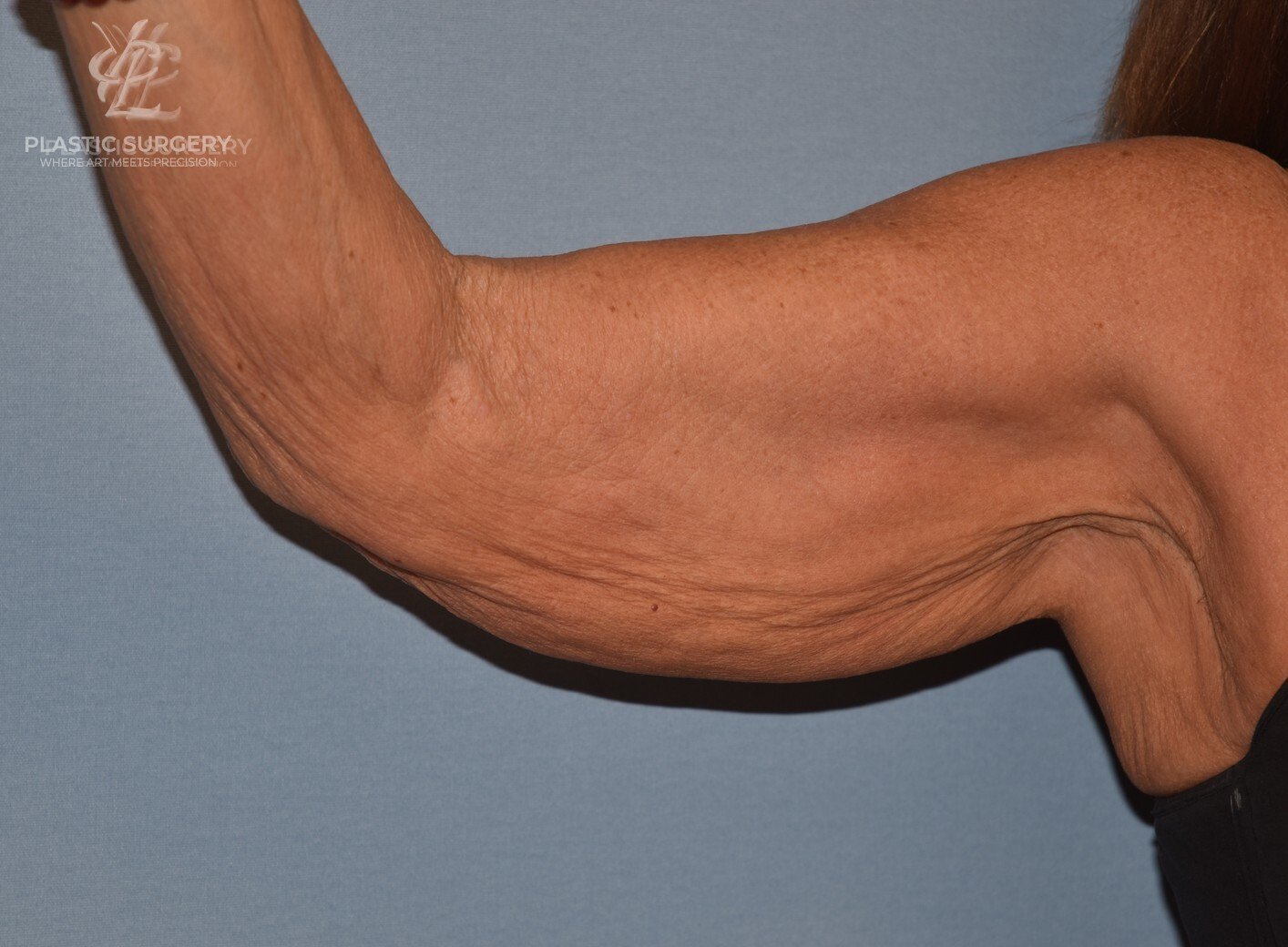 Brachioplasty (Arm Lift), patient 3, before, view 1