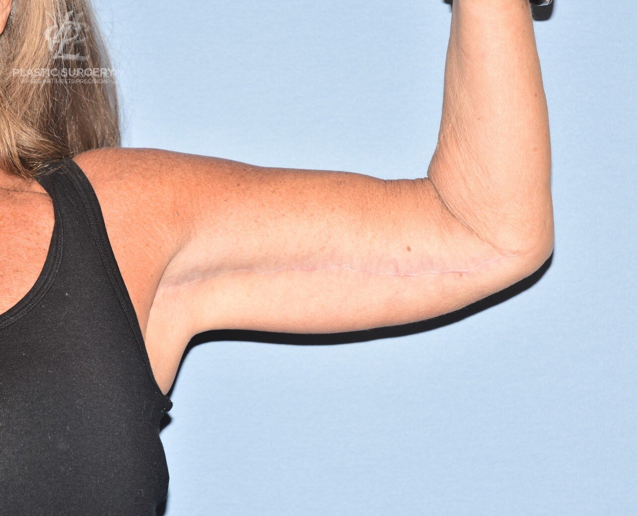 Brachioplasty (Arm Lift), patient 3, after, view 2