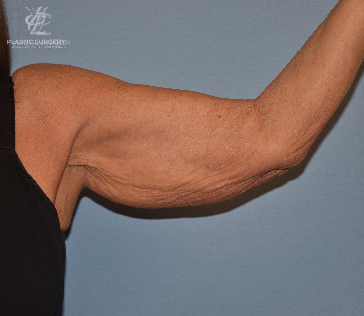 Brachioplasty (Arm Lift), patient 3, before, view 2