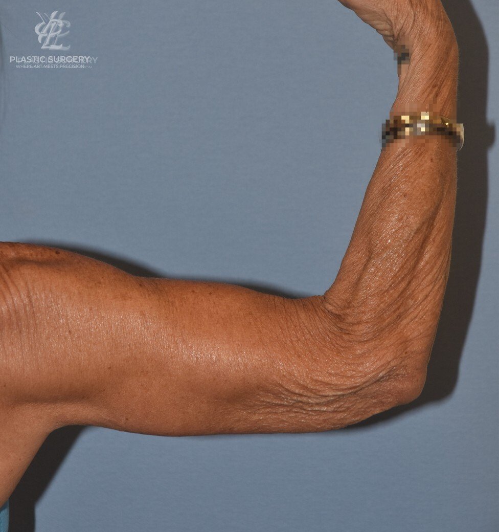 Brachioplasty (Arm Lift), patient 3, after, view 3