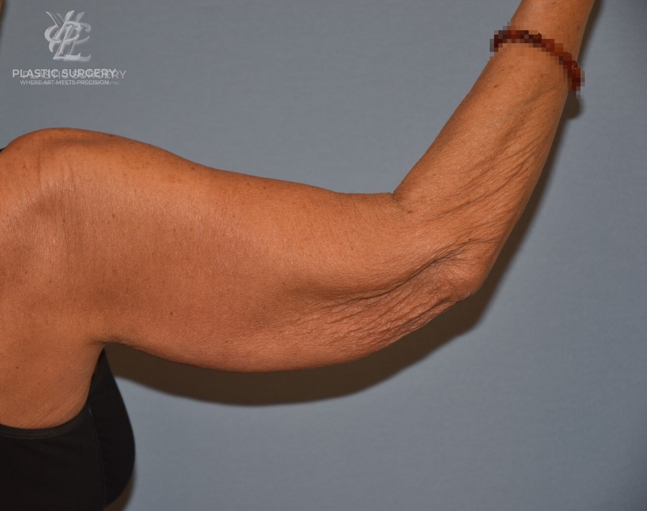 Brachioplasty (Arm Lift), patient 3, before, view 3