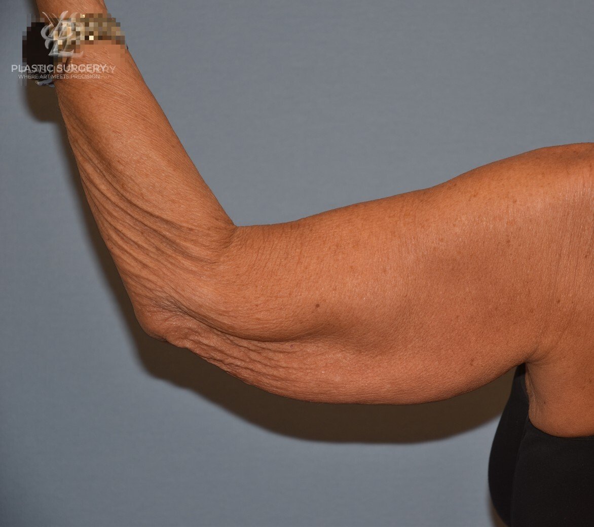 Brachioplasty (Arm Lift), patient 3, before, view 4