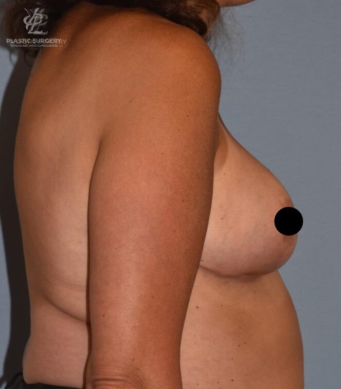 Breast Asymmetry Correction, patient 1, after, view 3