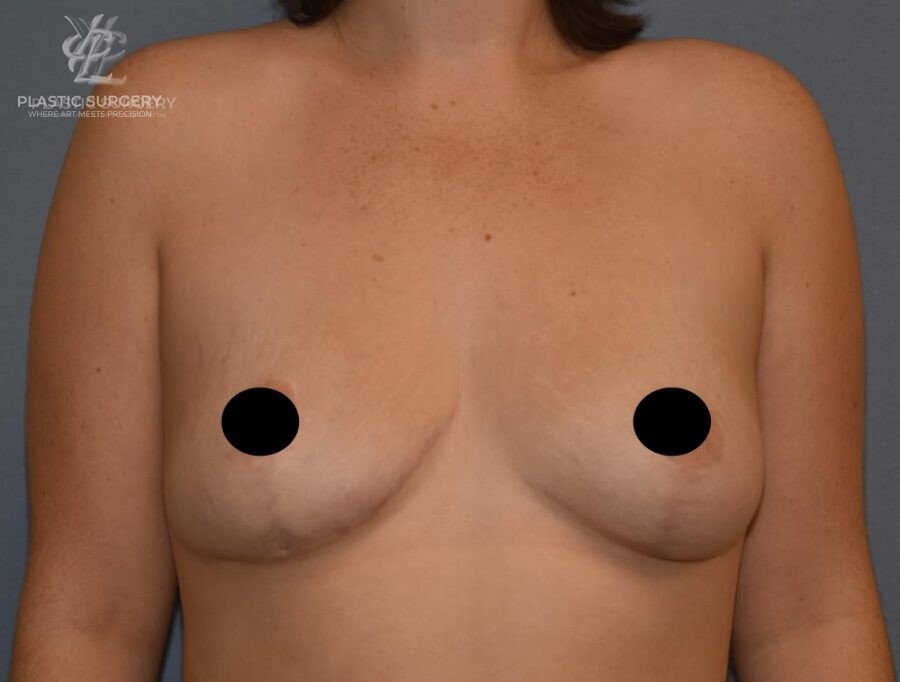 Breast Asymmetry Correction, patient 2, after, view 1