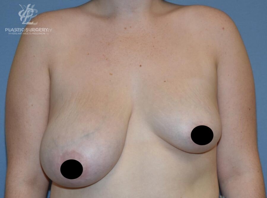 Breast Asymmetry Correction, patient 2, before, view 1