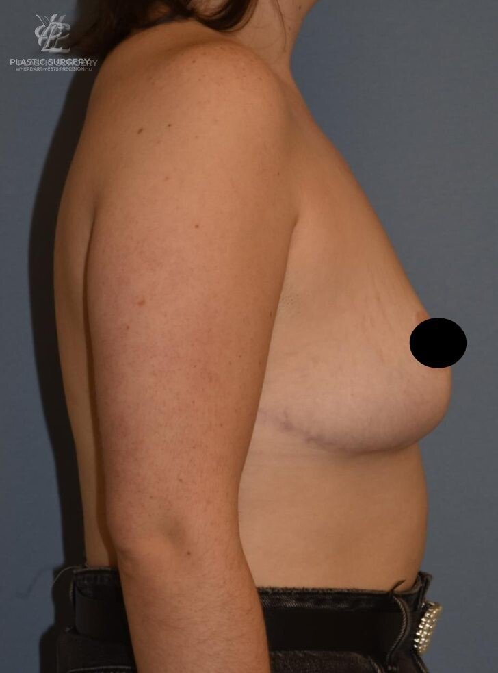 Breast Asymmetry Correction, patient 2, after, view 3