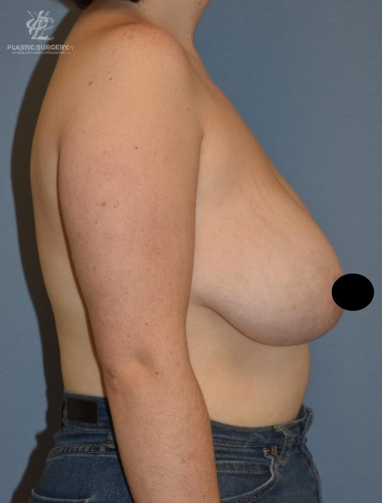 Breast Asymmetry Correction, patient 2, before, view 3