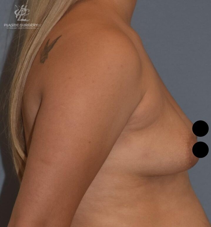 Breast Asymmetry Correction, patient 4, before, view 3