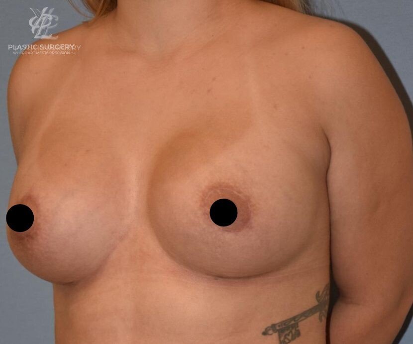 Breast Asymmetry Correction, patient 4, after, view 2
