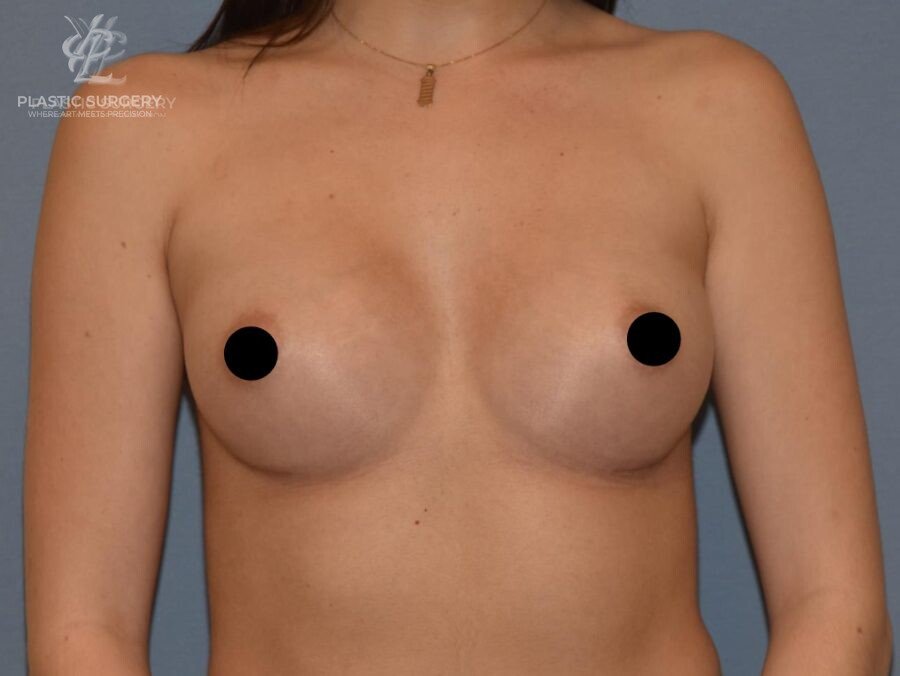 Breast Augmentation, patient 1, after, view 1