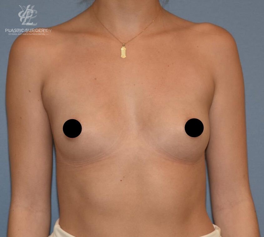 Breast Augmentation, patient 1, before, view 1