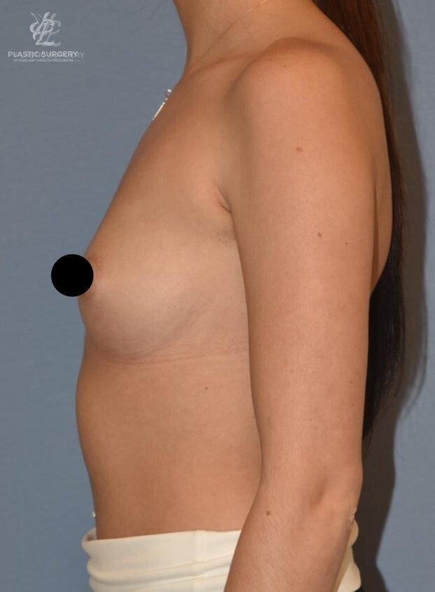 Breast Augmentation, patient 1, before, view 3
