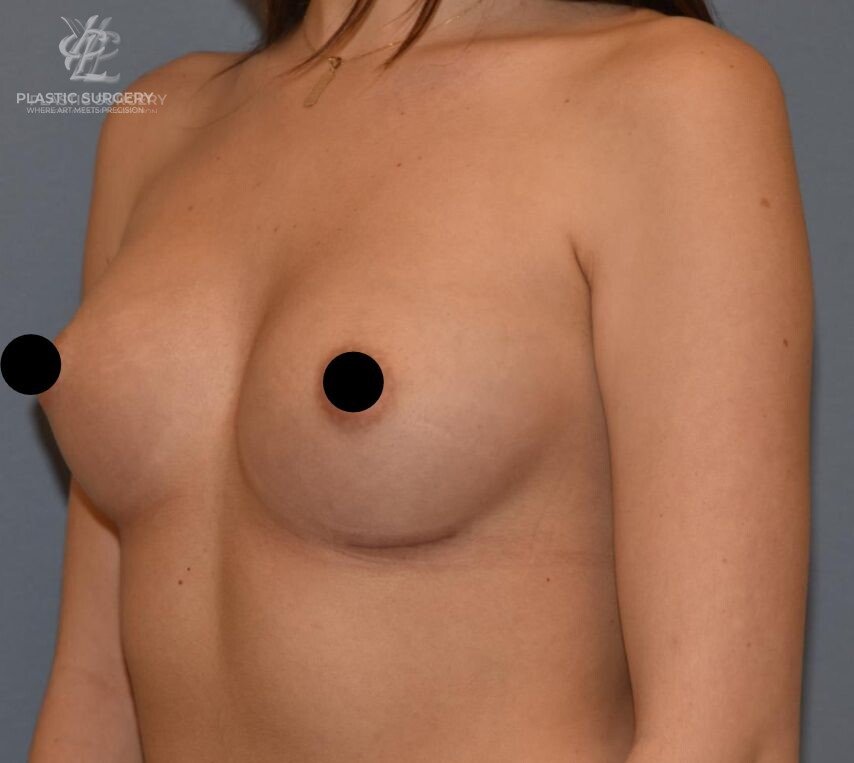 Breast Augmentation, patient 1, after, view 2