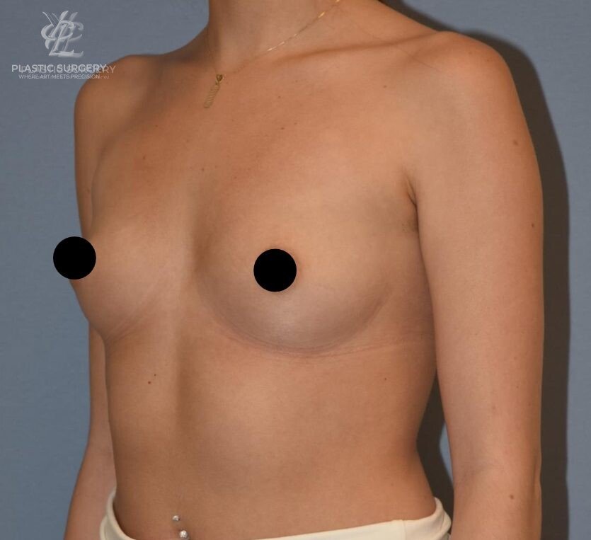Breast Augmentation, patient 1, before, view 2