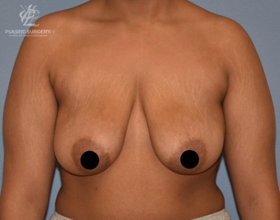 Breast Augmentation, patient 2, before, view 1