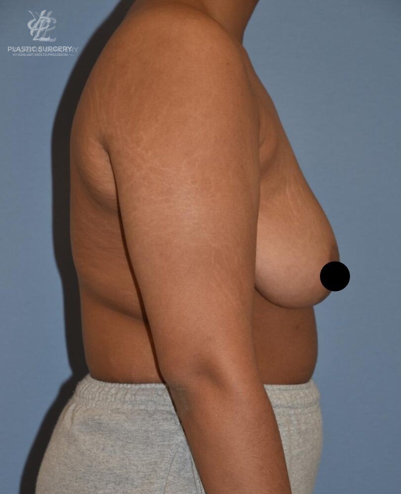Breast Augmentation, patient 2, before, view 3