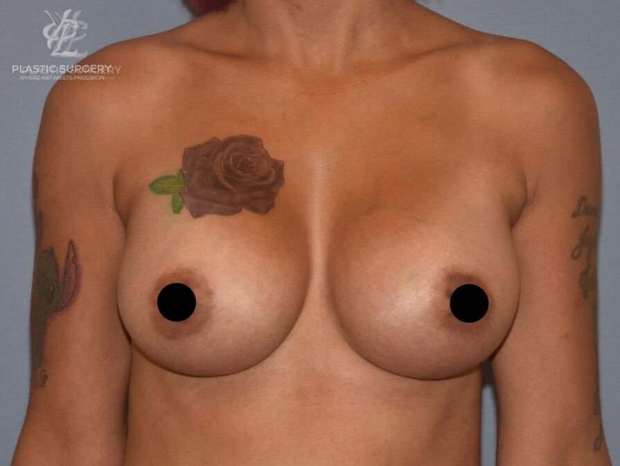 Breast Augmentation, patient 3, after, view 1