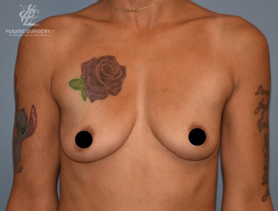 Breast Augmentation, patient 3, before, view 1