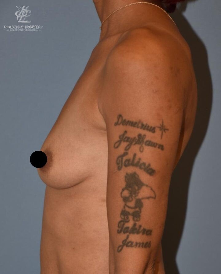 Breast Augmentation, patient 3, before, view 3