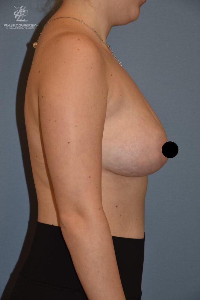 Breast Augmentation, patient 4, after, view 3