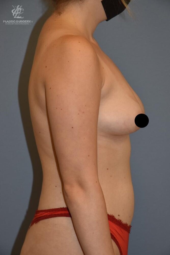 Breast Augmentation, patient 4, before, view 3
