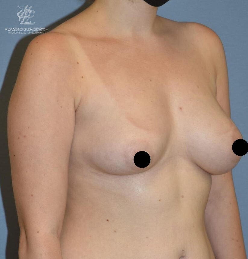 Breast Augmentation, patient 4, before, view 2