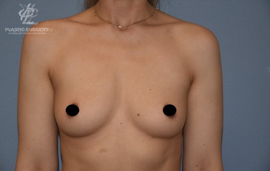 Breast Augmentation, patient 6, before, view 1