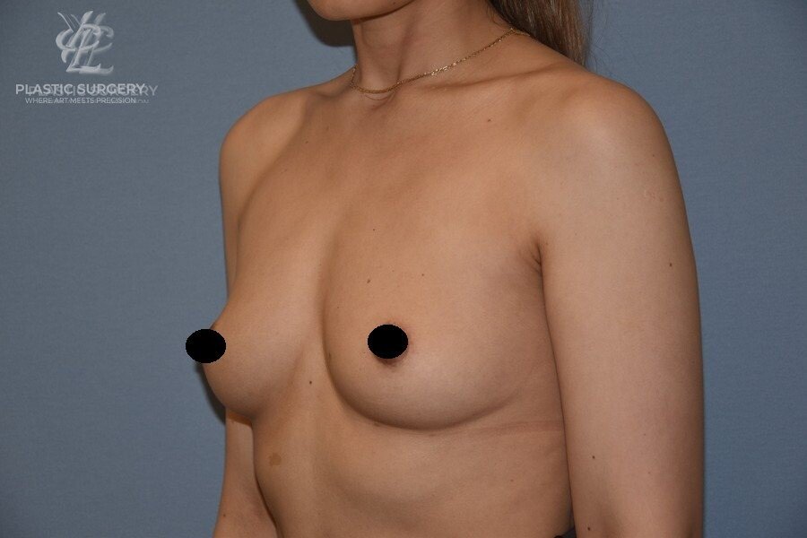 Breast Augmentation, patient 6, before, view 2